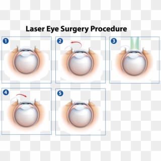 Laser Eye Surgery Procedure - Lasek Eye Surgery Diagram, HD Png ...