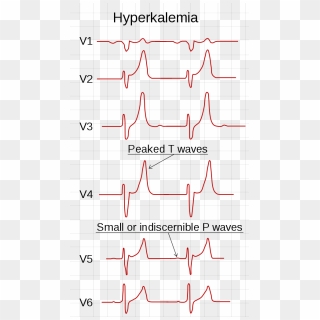 Ecg Ft - Ecg Ft 33, HD Png Download - 470x756 (#347889) - PinPng