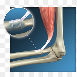 Endoscopic Distal Biceps Reinsertion Surgery, Toulouse - Ruptura Distal ...