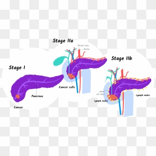 Cancer Stages - Many Stages Of Cancer, HD Png Download - 1406x695 ...